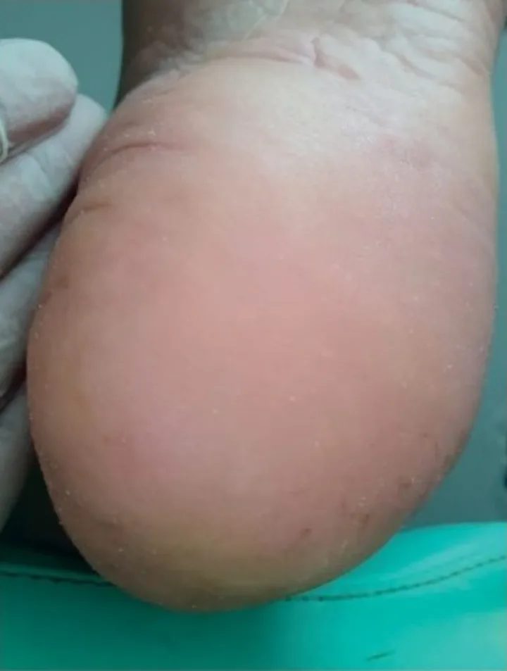 O mesmo calcanhar depois do atendimento, com a pele mais lisa